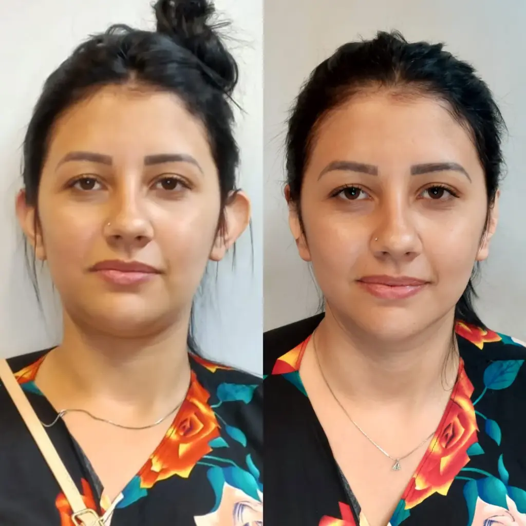 correção de orelhas com especialista