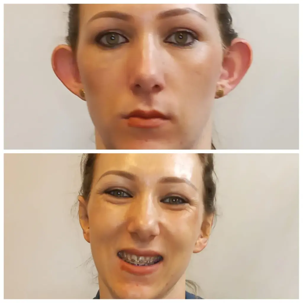 correção de orelhas com especialista