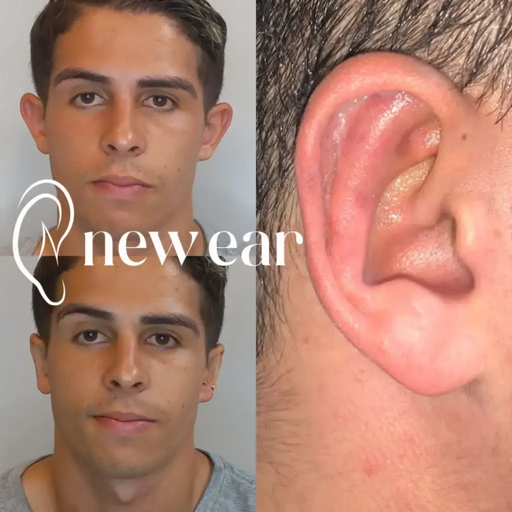 correção de orelhas com especialista