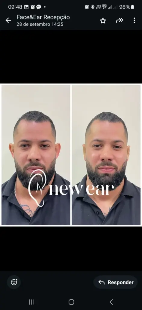 correção de orelhas com especialista