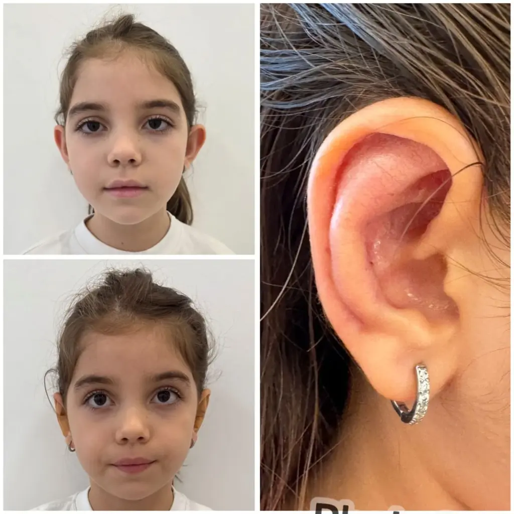 correção de orelhas com especialista